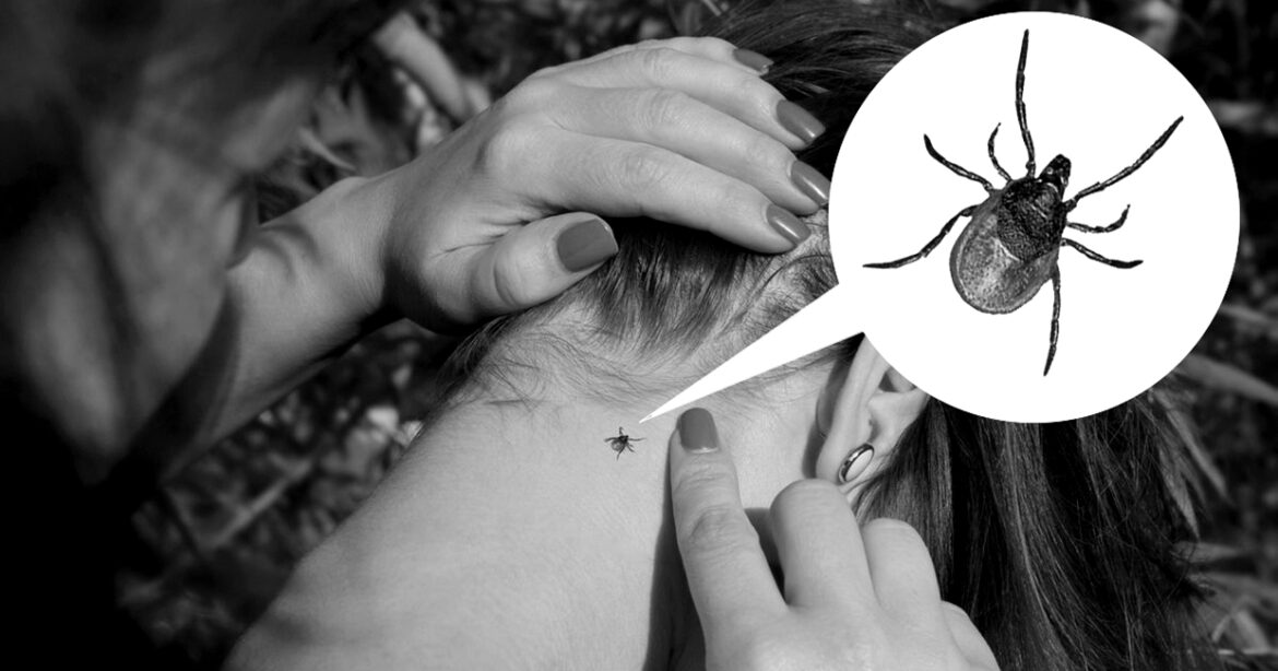 21857474 — people looking at wood tick embedded in human skin